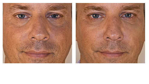 juvederm-03.jpg